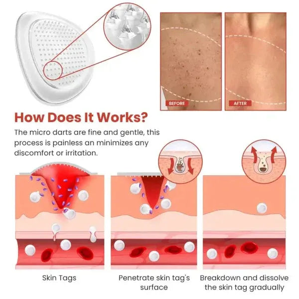 DermaSmooth Skin Tag Remover Patch - DGN Mart